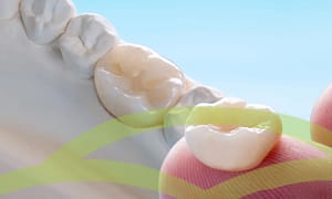 Dental crowns fix tooth problems.