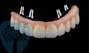 Get full mouth dental implants.