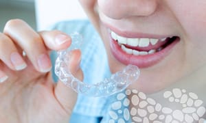 Choose SureSmile Clear Aligners to straighten your teeth.