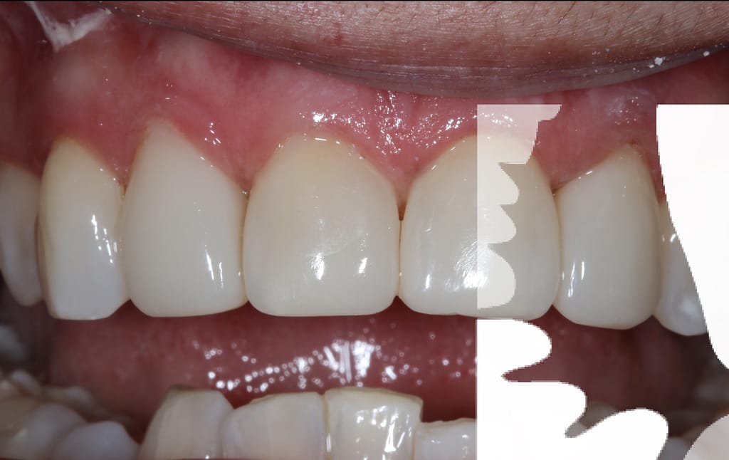 Understanding Bioclear.