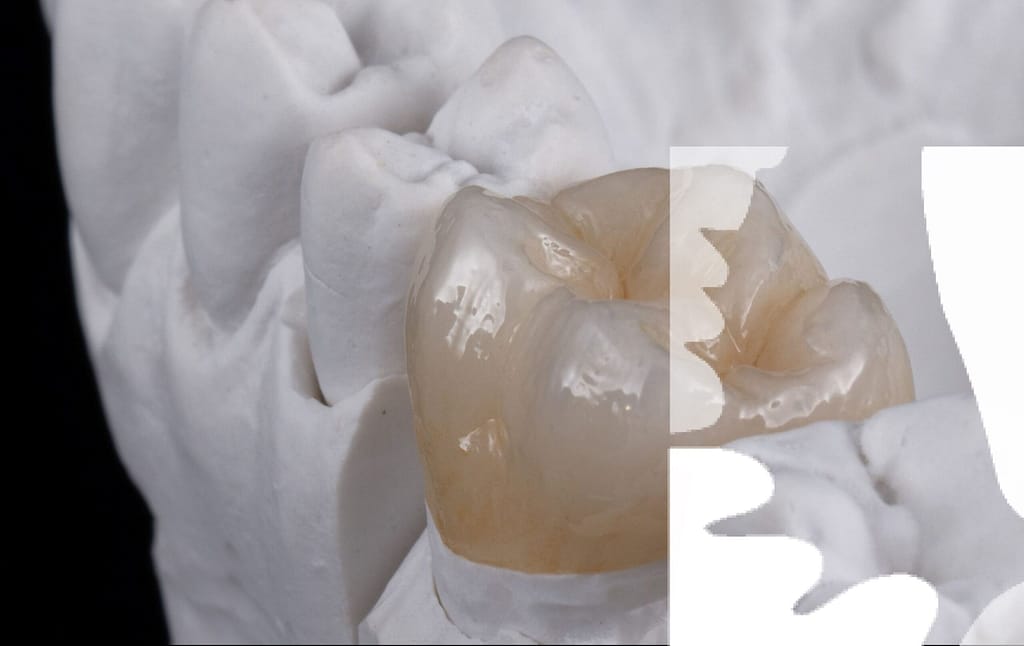 Restore your smile with zirconia crowns.