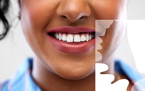 Bioclear fills in tooth gaps.