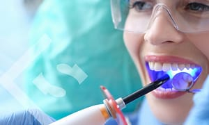 Composite bonding FAQ's