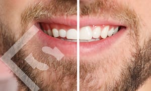 Fix your smile with gum contouring.