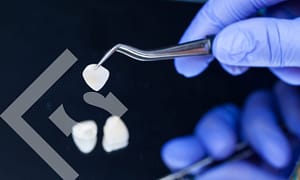 Enjoy the magic of dental veneers.