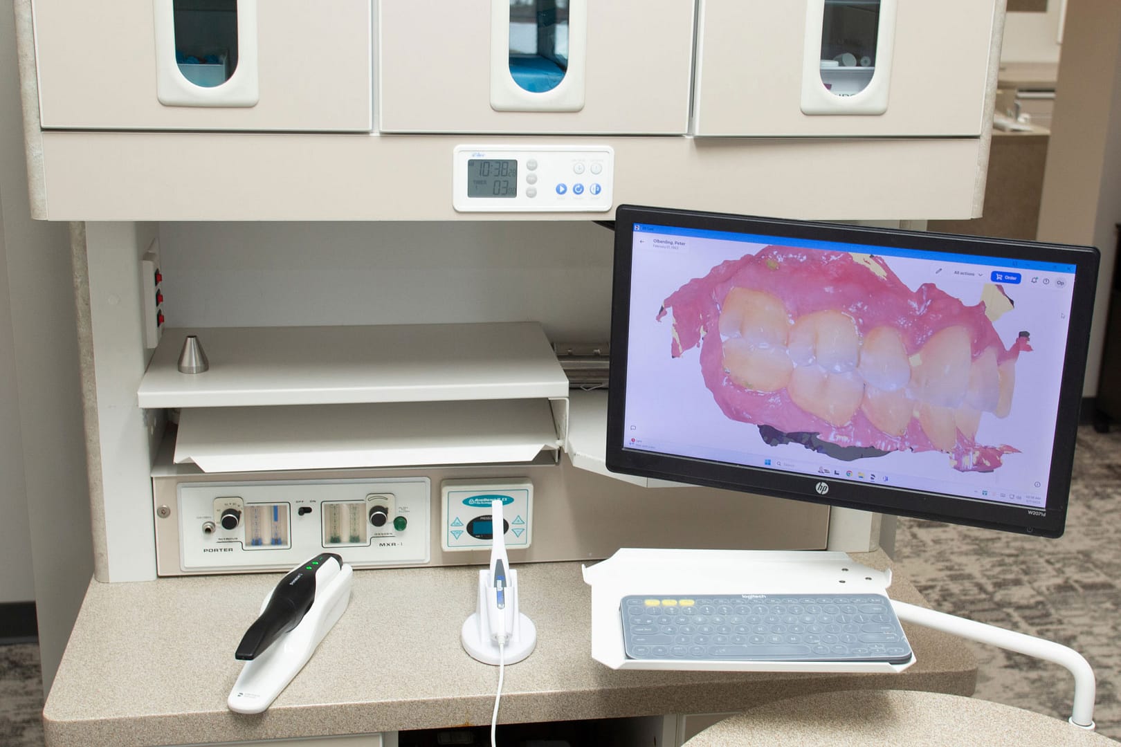close up of intraoral camera and computer monitor showing dental scan in exam room