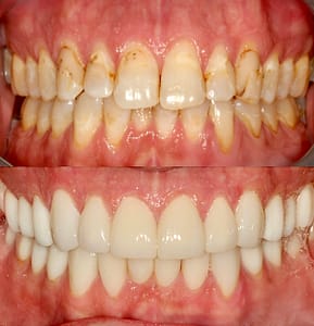 actual patient Full mouth restoration with porcelain crowns before and after