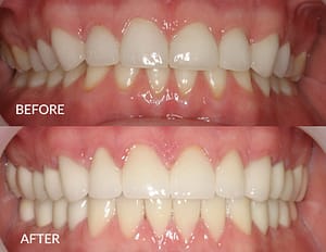 Alex before and after