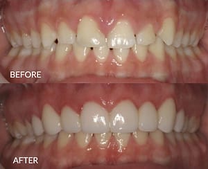 Caroline Before and After