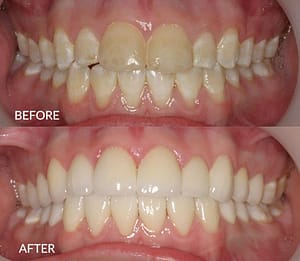 Veneers before and after