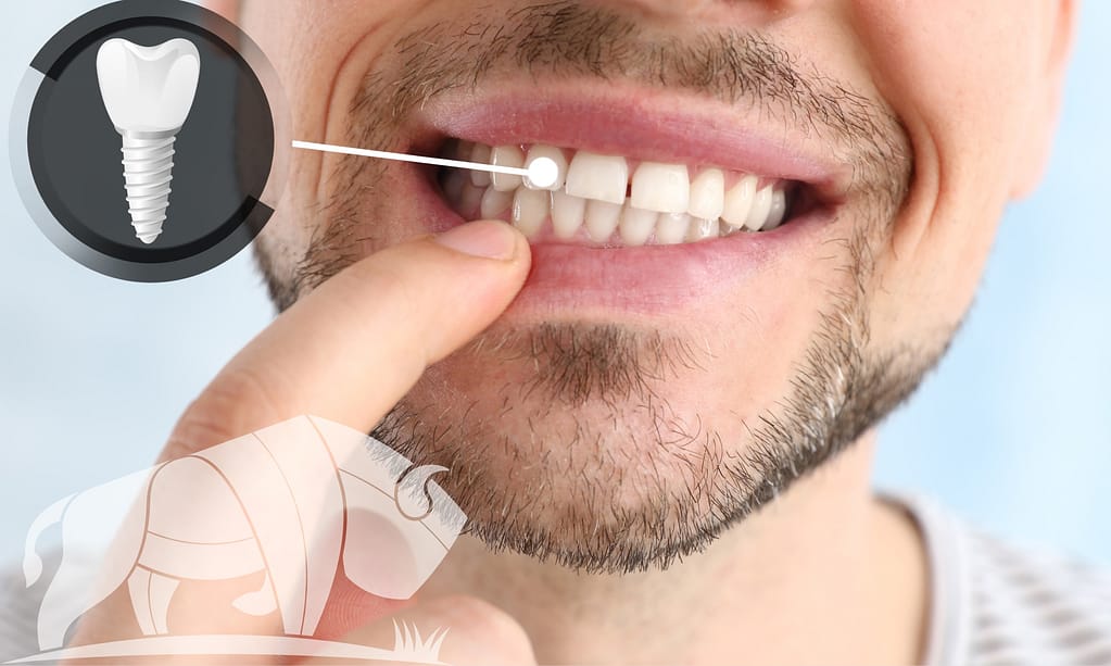 Replace missing teeth with dental implants.