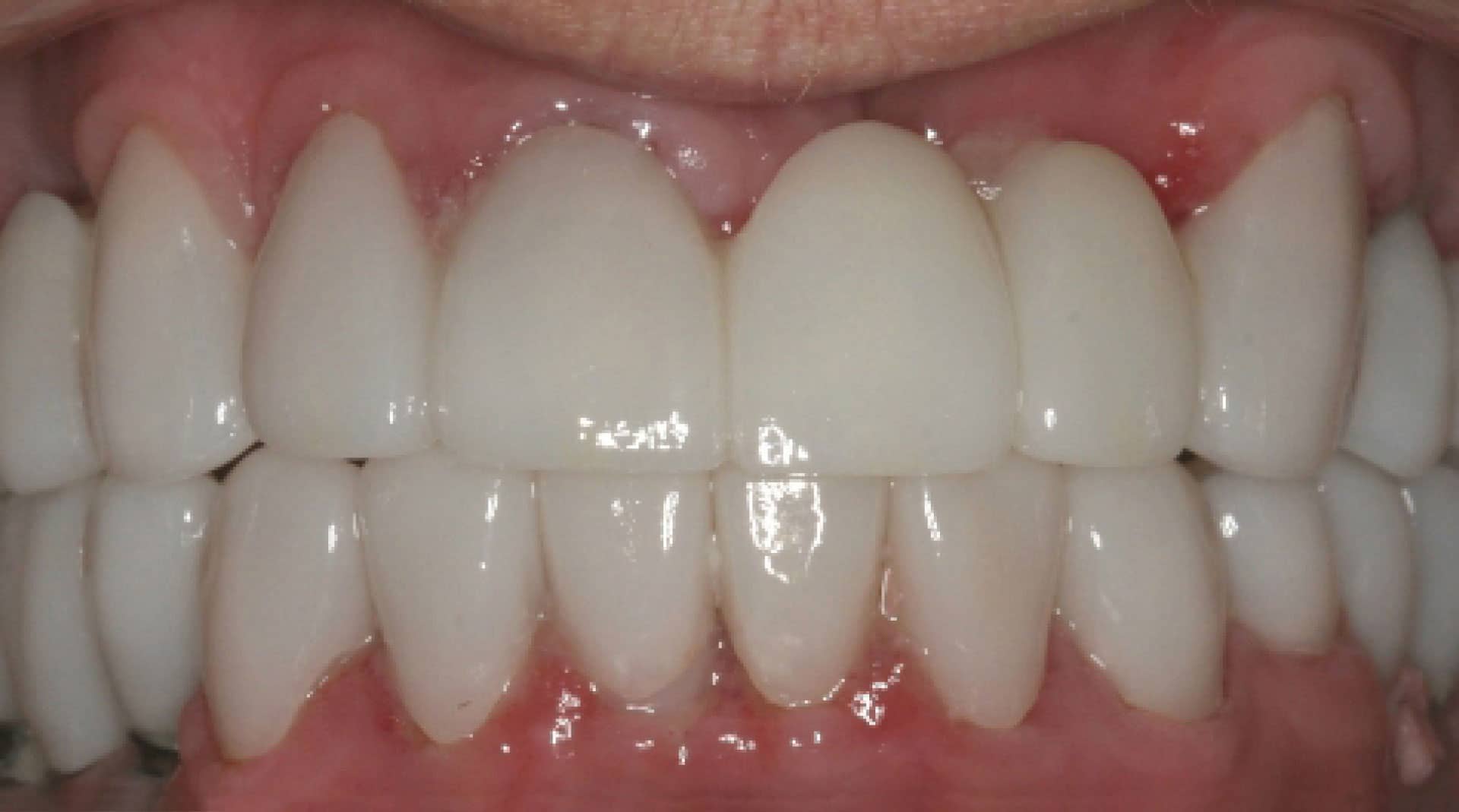 Implants After