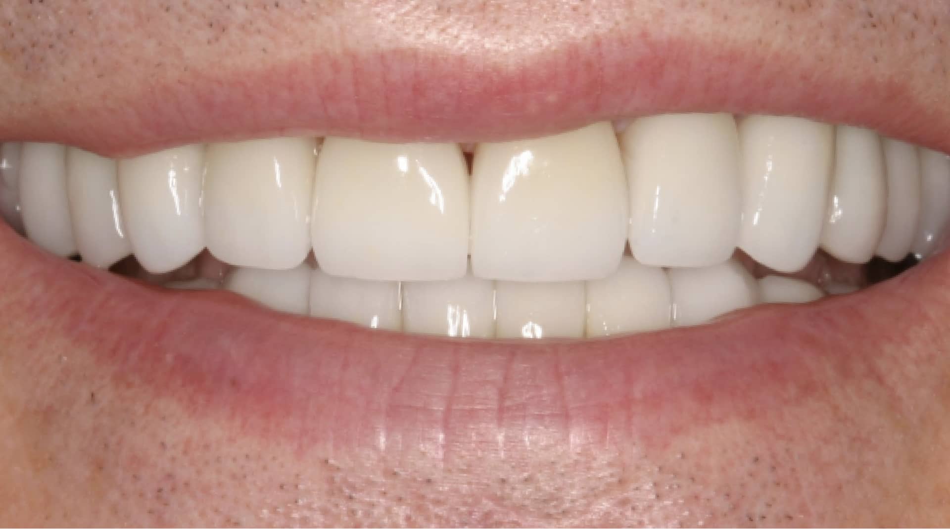 actual patient full mouth restoration after