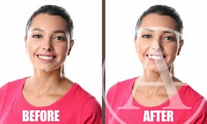 Transform your smile with gum contouring.