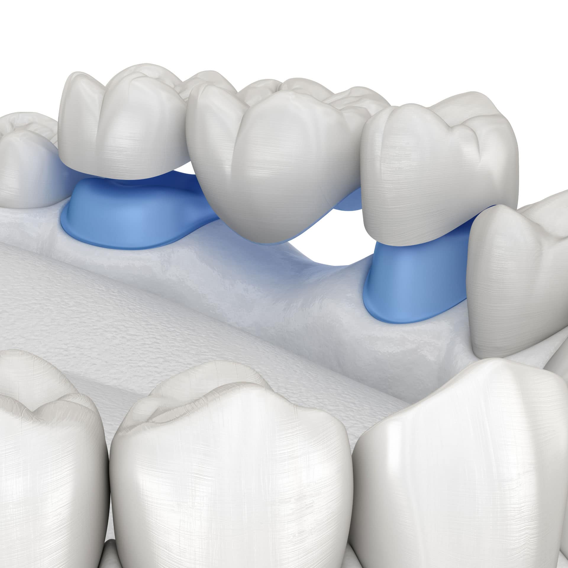 illustration of dental bridge being placed in mouth