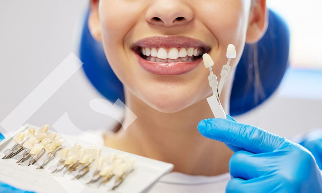 Time to choose dental veneers.