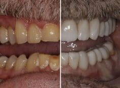 crowns veneers before and after