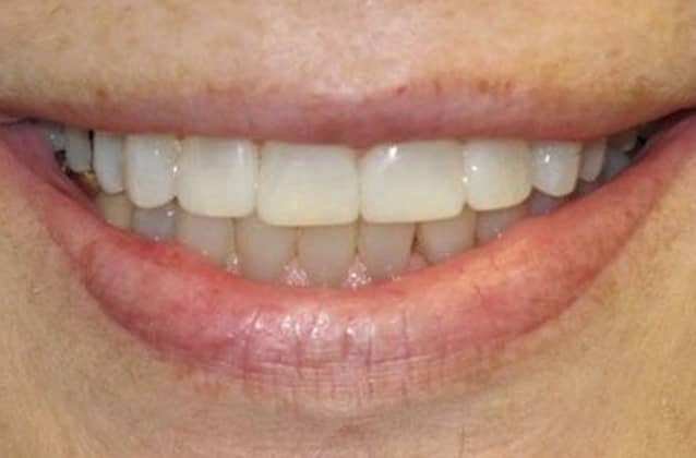 bonding-case5-after