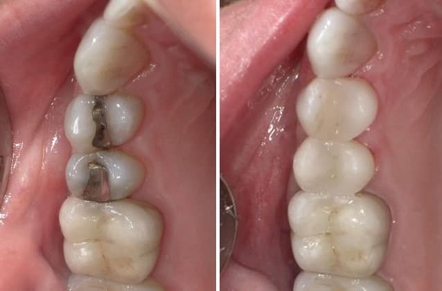 cerec-case10 cerec-case10