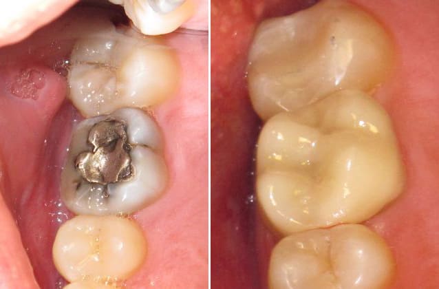 cerec-case2 cerec-case2