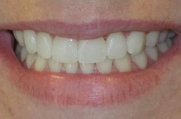 cerec-case6-after