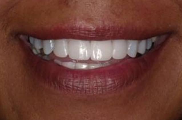 cosmetic-case4-after