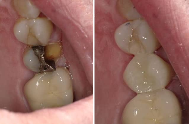 crowns-case11 crowns-case11