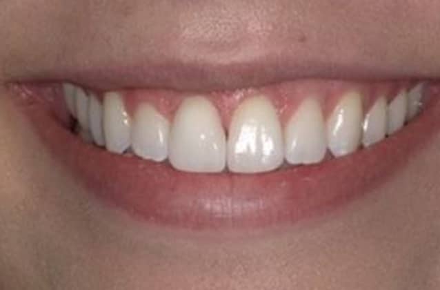 Actual Patient Crowns Case 12 after result