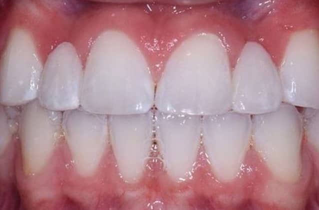 implants-case7-after