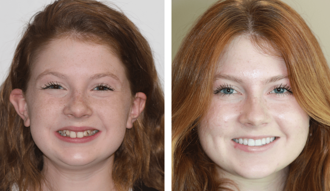 premier-patient-before-after