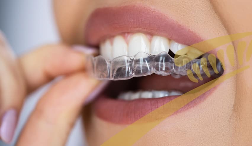 Clear aligner therapy for teens and adults.