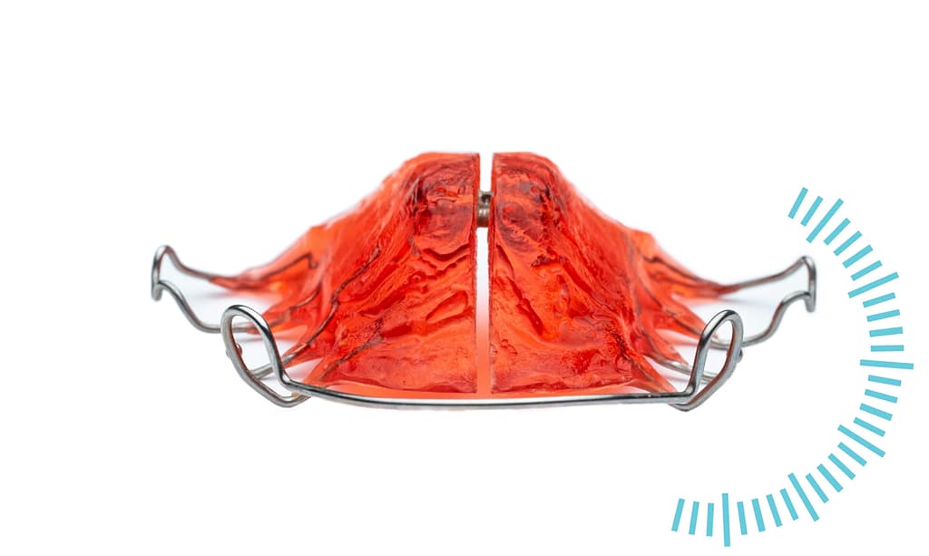 Understanding palatal expanders.