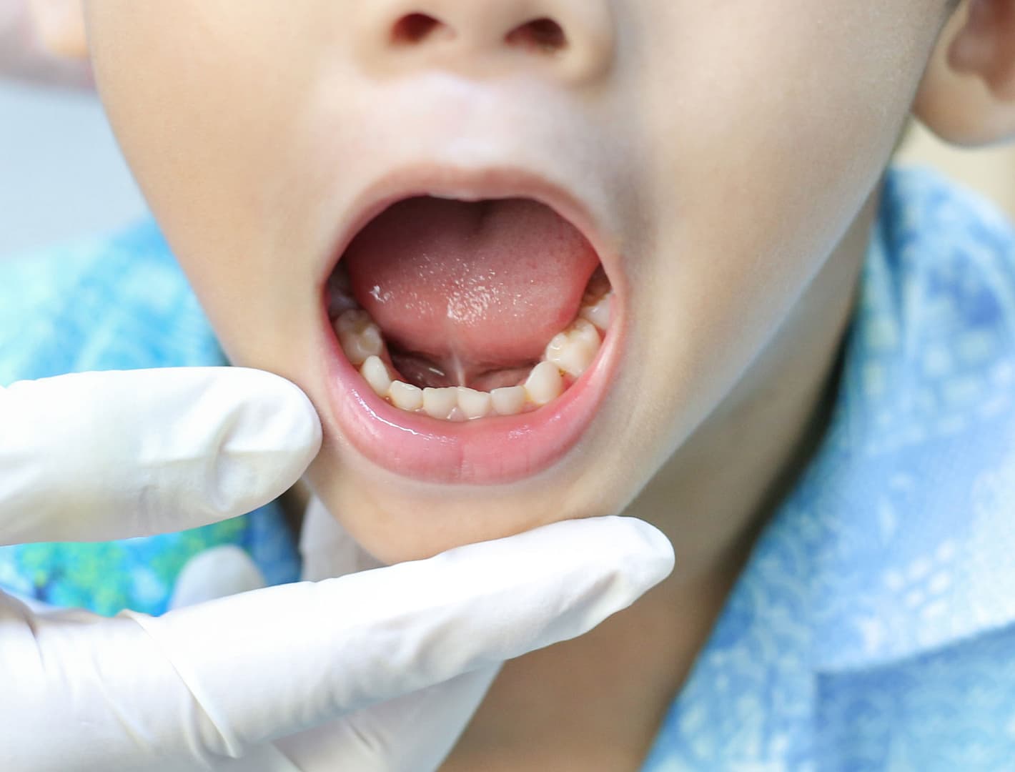child patient that needs frenectomy