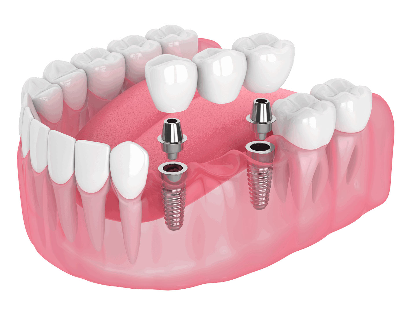 model of dental bridge with implants