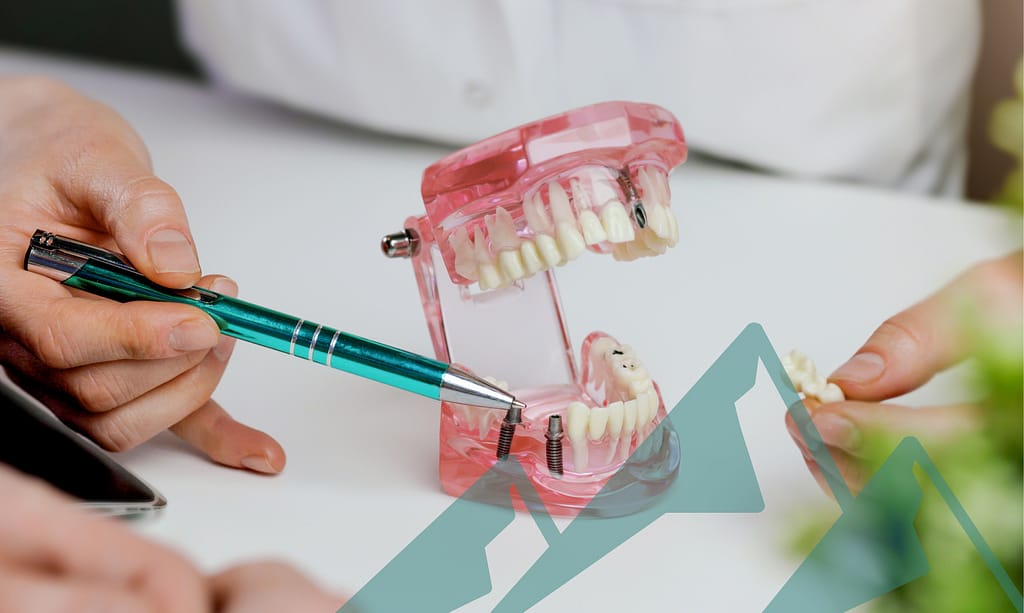dental-implants (8) Replace missing teeth with dental implants.