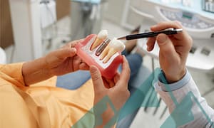 Your guide to dental implants.