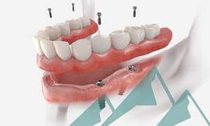 Implant-supported dentures