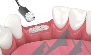 What to expect with bone grafting.