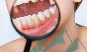 Plaque vs. tartar