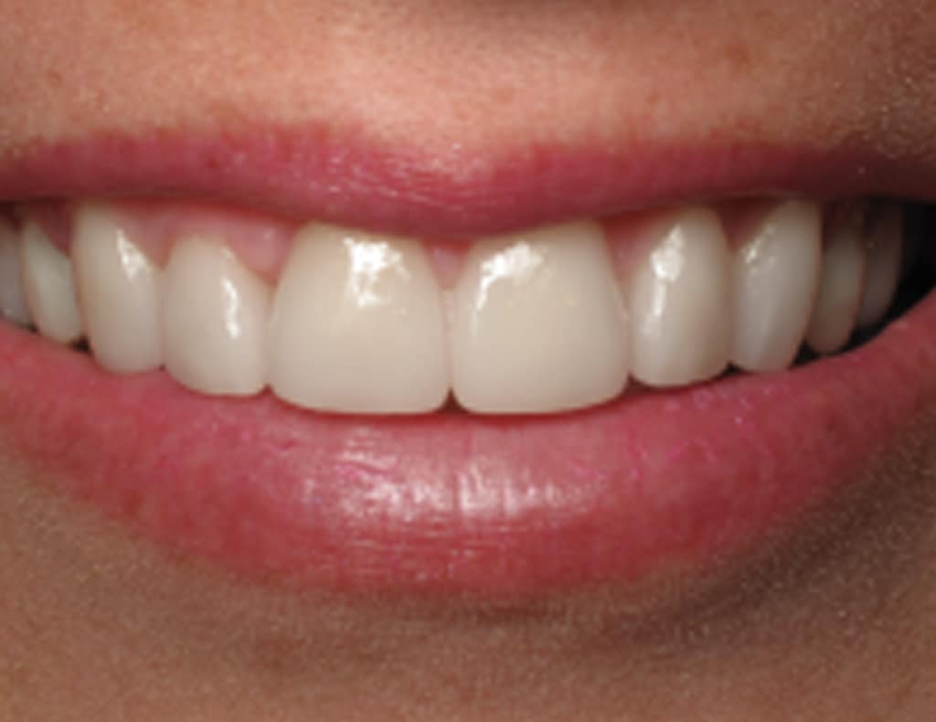 Actual patient after photo