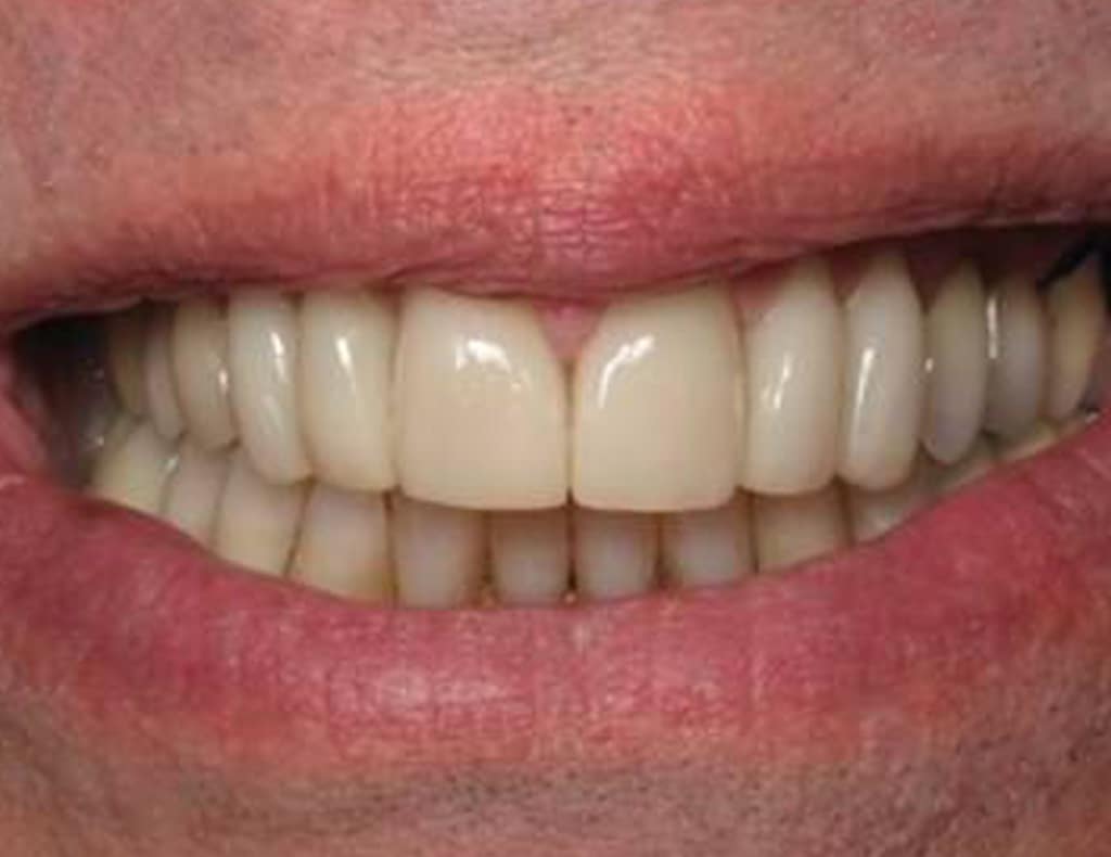 Actual patient after photo