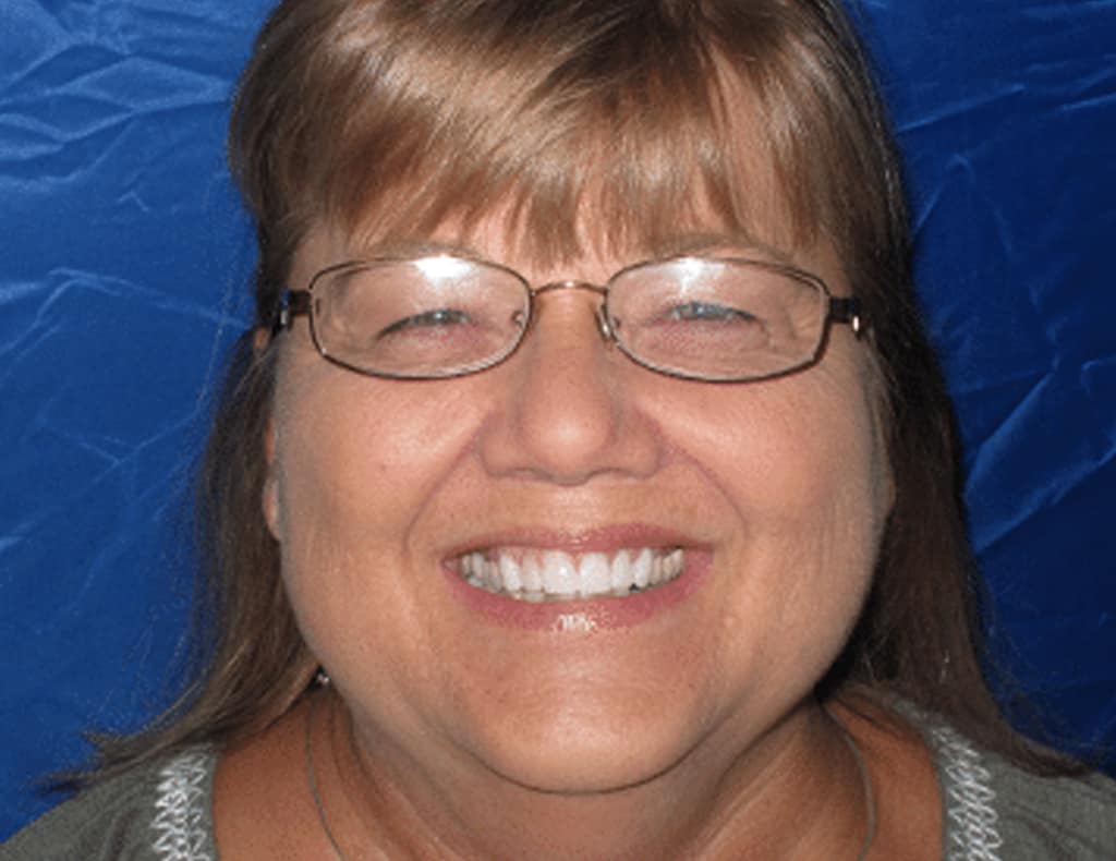 Actual patient after photo