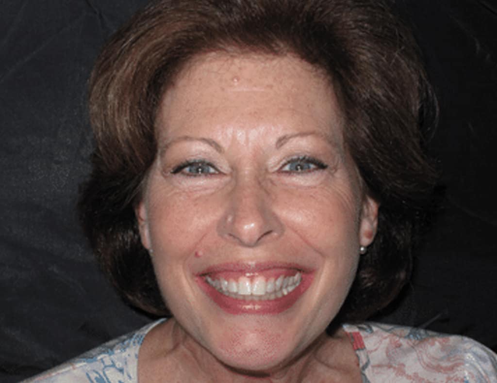 Actual patient after photo