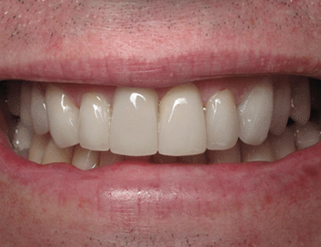 Actual patient after photo