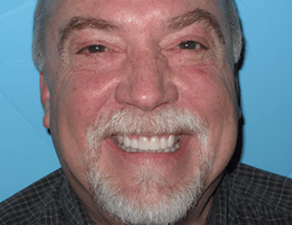 Actual Patient after photo