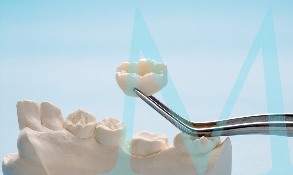 Dental-Crowns (1) Dental crowns improve oral health.