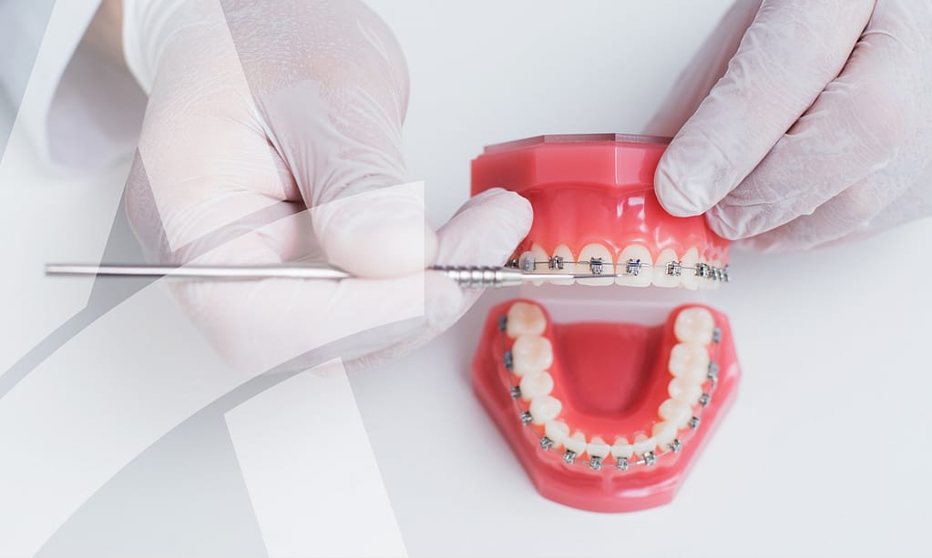 Straight wire orthodontics give strong results.