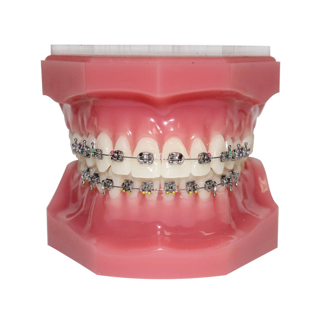 【裁断済】Limited Orthodontic Treatment(LOT) Bracketed Typodont - Ortho Arch