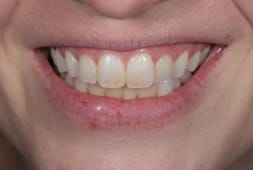 Yellow teeth