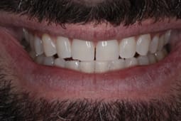 Teeth Whitening New Bern Tennesse